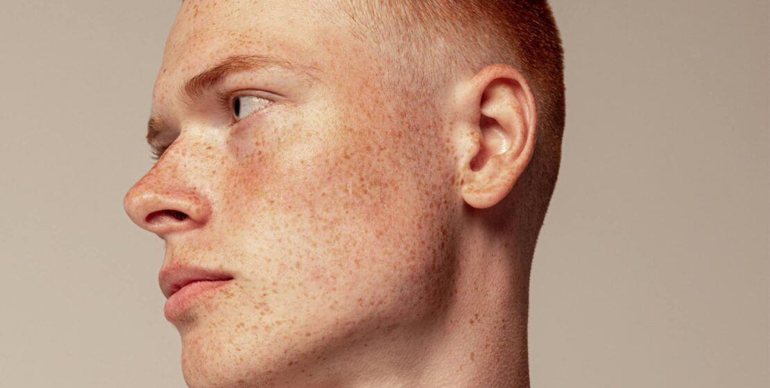 Microneedling